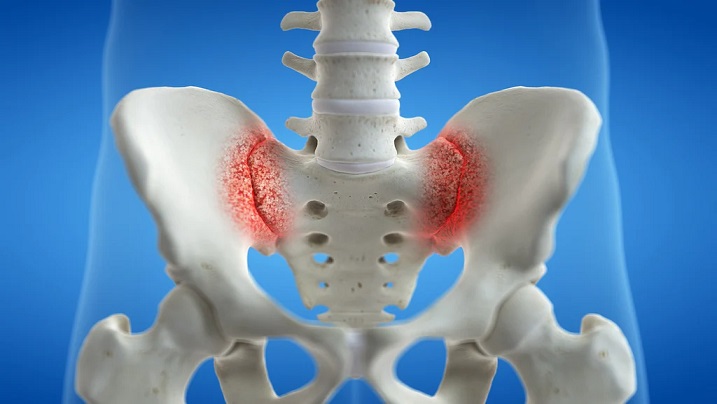 Understanding Sacroiliac Joint Fusion: A Path to Pain Relief